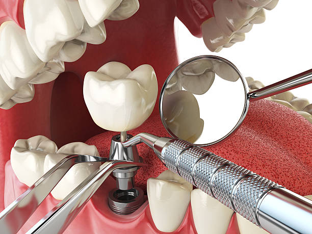 Best Emergency Tooth Extraction in Algood, TN
